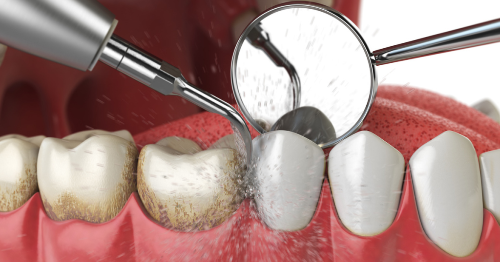 Ilustração odontológica detalhada mostrando um procedimento de limpeza profunda: uma cureta dental remove o tártaro acumulado nos dentes com manchas e acúmulo de placa bacteriana, revelando dentes limpos e brancos. Um espelho clínico e o jato de água estão presentes