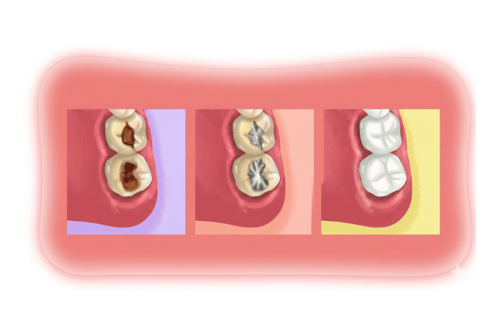 dra.amanda apresentando Restauração dentaria em uma ilustração.