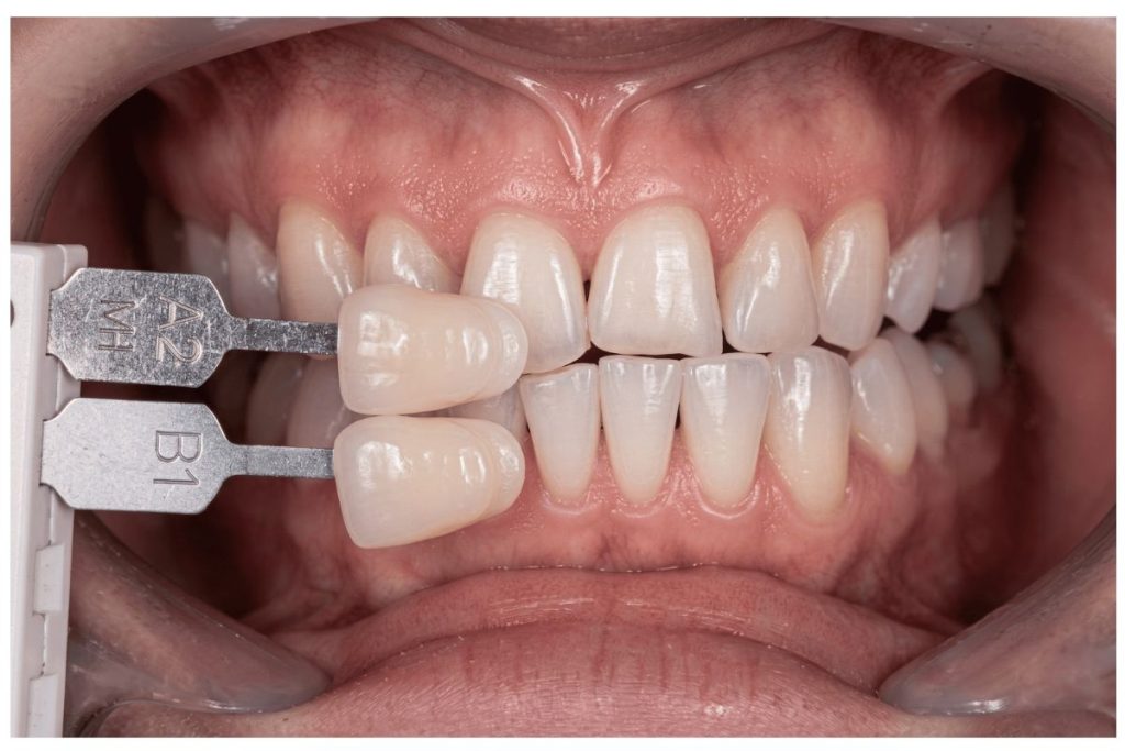 Comparação técnica de cor dental utilizando escala Vita Classical com foco na tonalidade B1 e escala 0.5 M1 em dentes naturais.