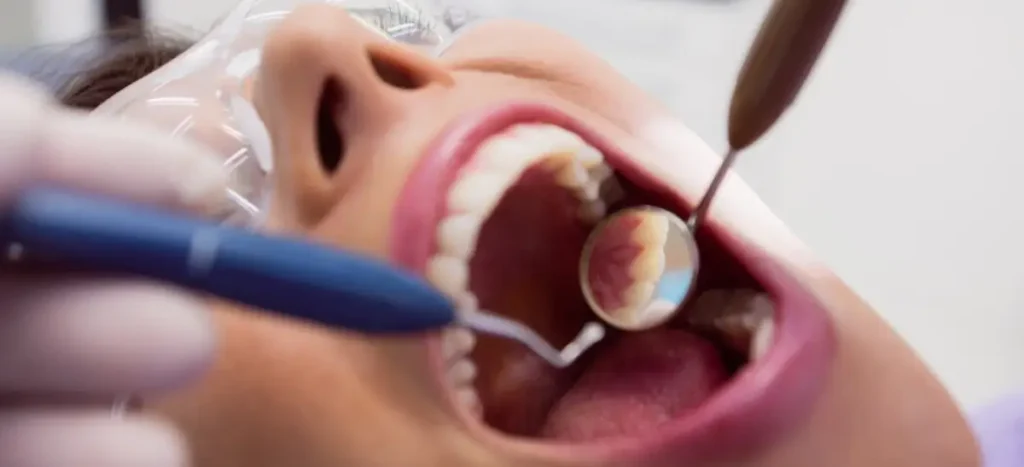 Close-up extremo da boca de uma paciente com um espelho dental e uma sonda odontológica em uso, mostrando detalhes dos dentes e tecidos orais, representando um exame dental minucioso e preciso realizado na clínica da Dra. Amanda Magre.