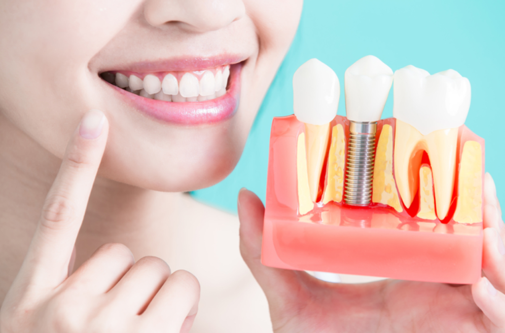 Close-up de uma mulher sorrindo e apontando para seu rosto, enquanto segura um modelo dental demonstrando um implante dentário de metal entre dois dentes coroados contra um fundo turquesa sólido.